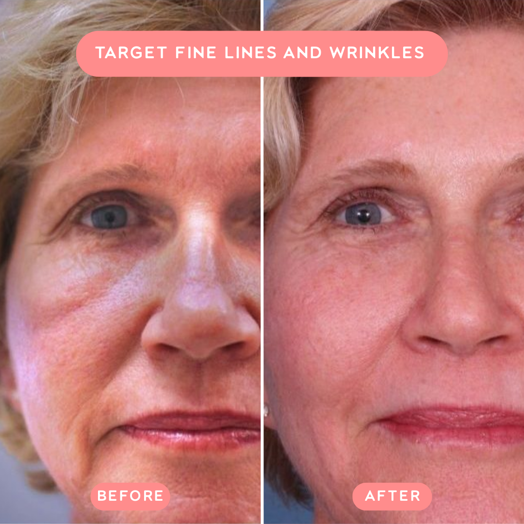 ReGlow™ Red Light Wrinkle Wand