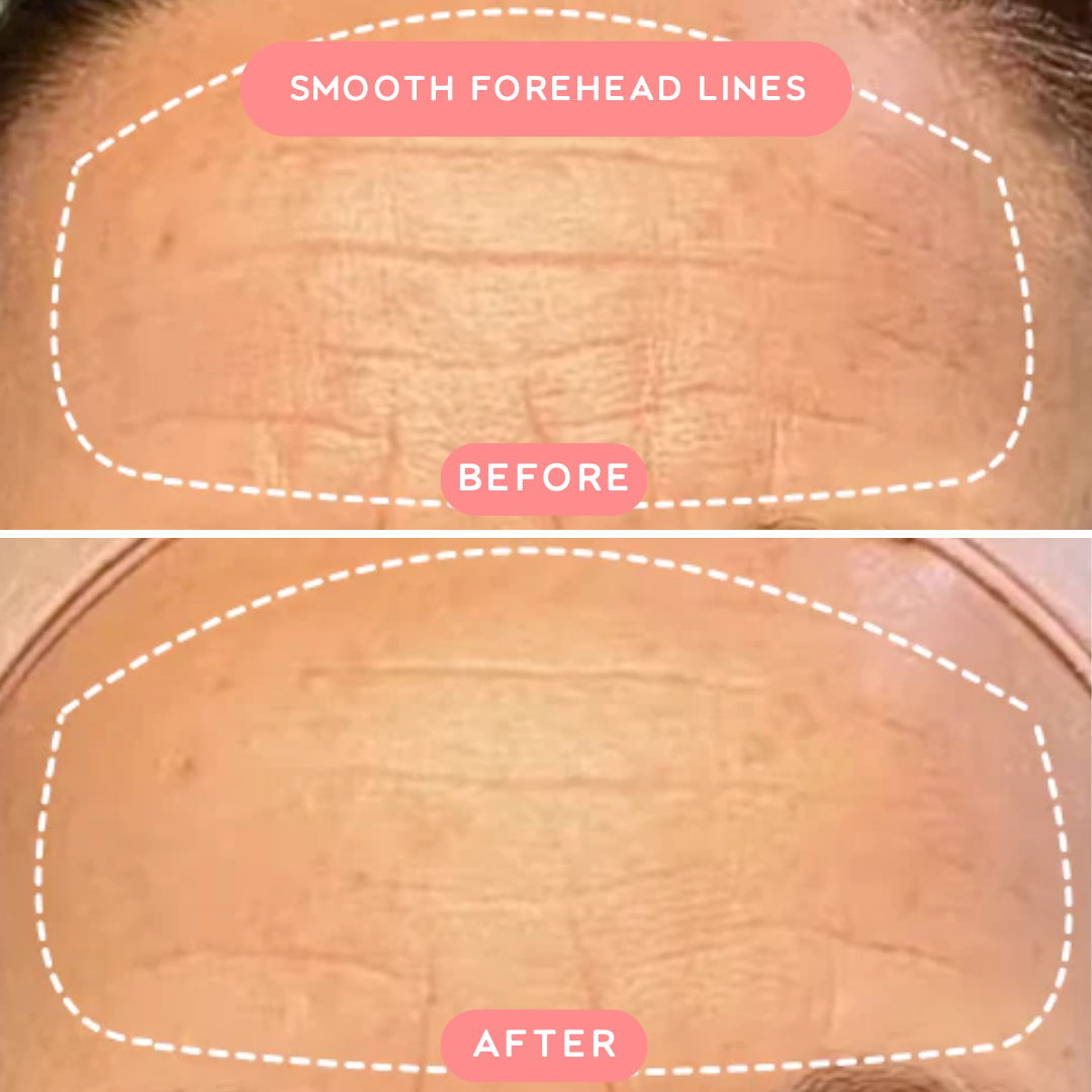 ReGlow™ Red Light Wrinkle Wand